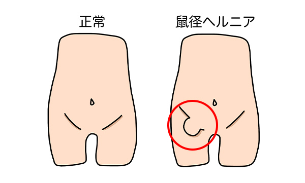 正常・鼠径ヘルニア