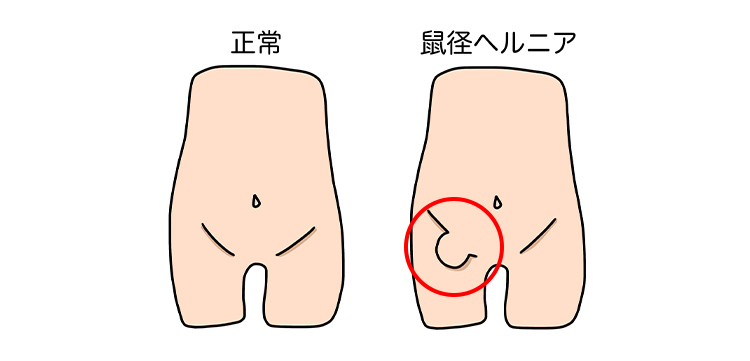 正常・鼠径ヘルニア