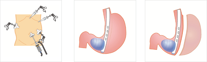 スリーブ状胃切除について