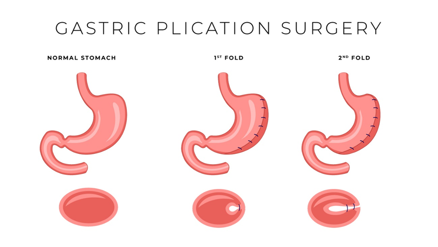 腹腔鏡下胃形成術（LGP）とは