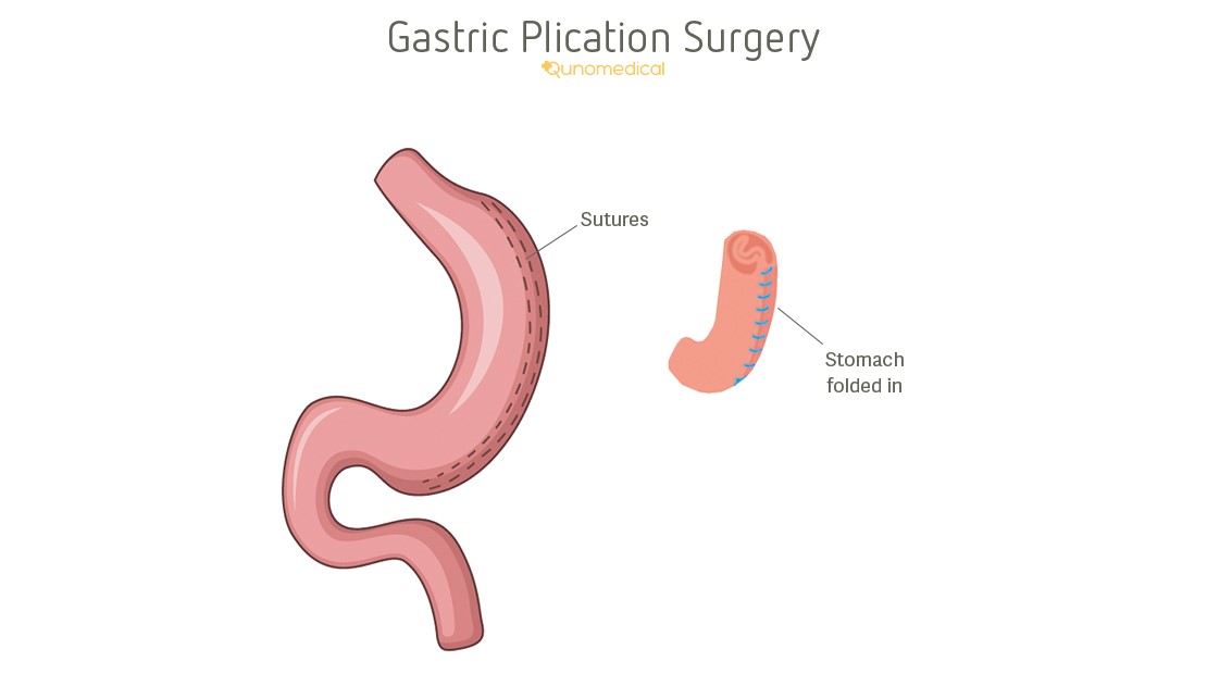 腹腔鏡下胃形成術（LGP）とは